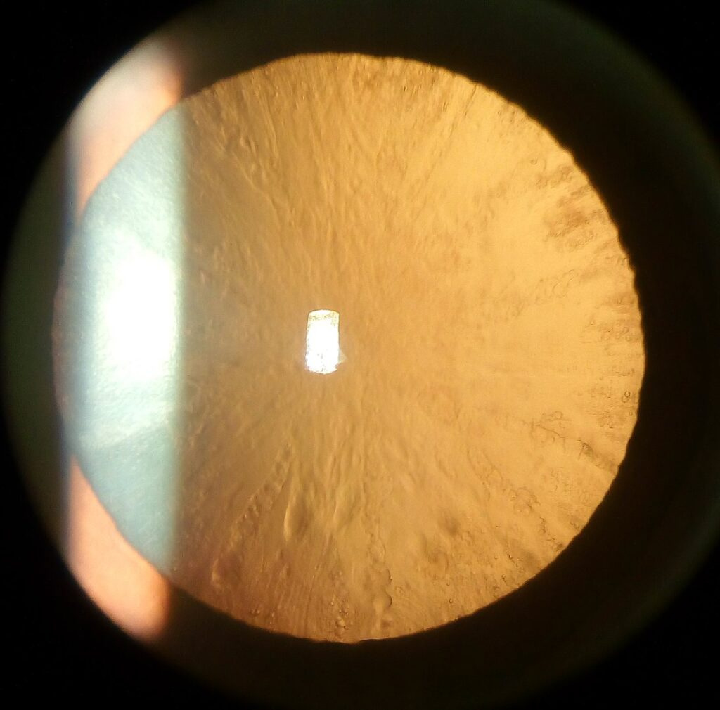 Cataracts