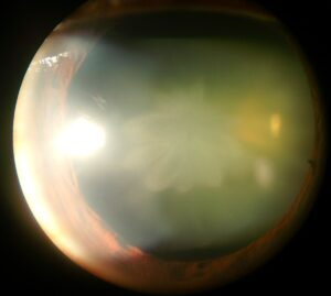 Cataracts