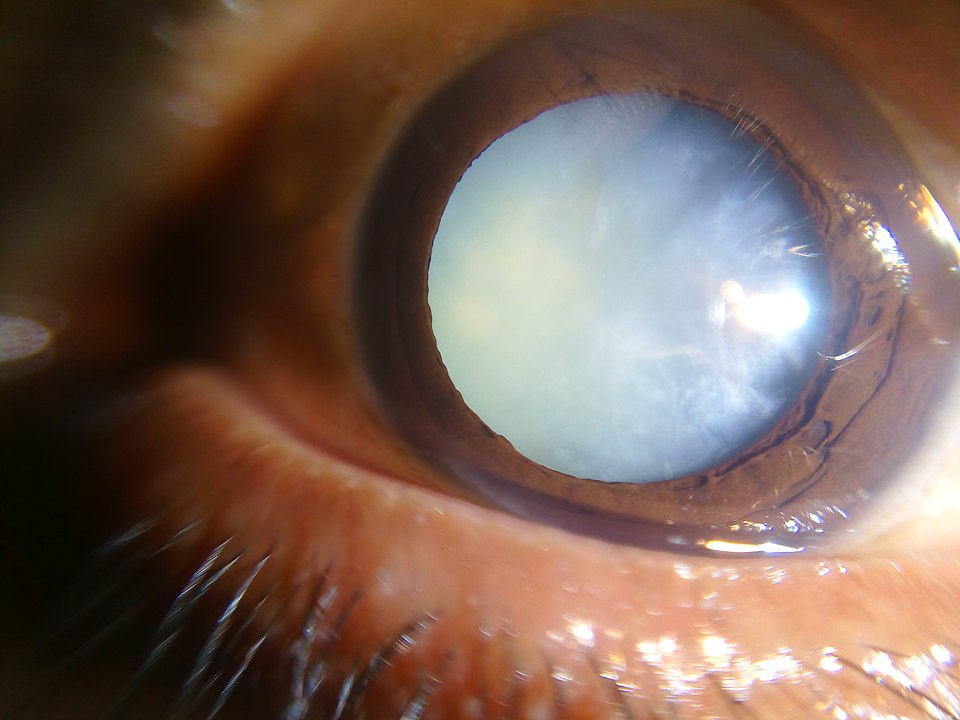 Cataracts Explained: Key Symptoms, Hidden Causes, Major Risks & Proven Treatments 4 Cataracts