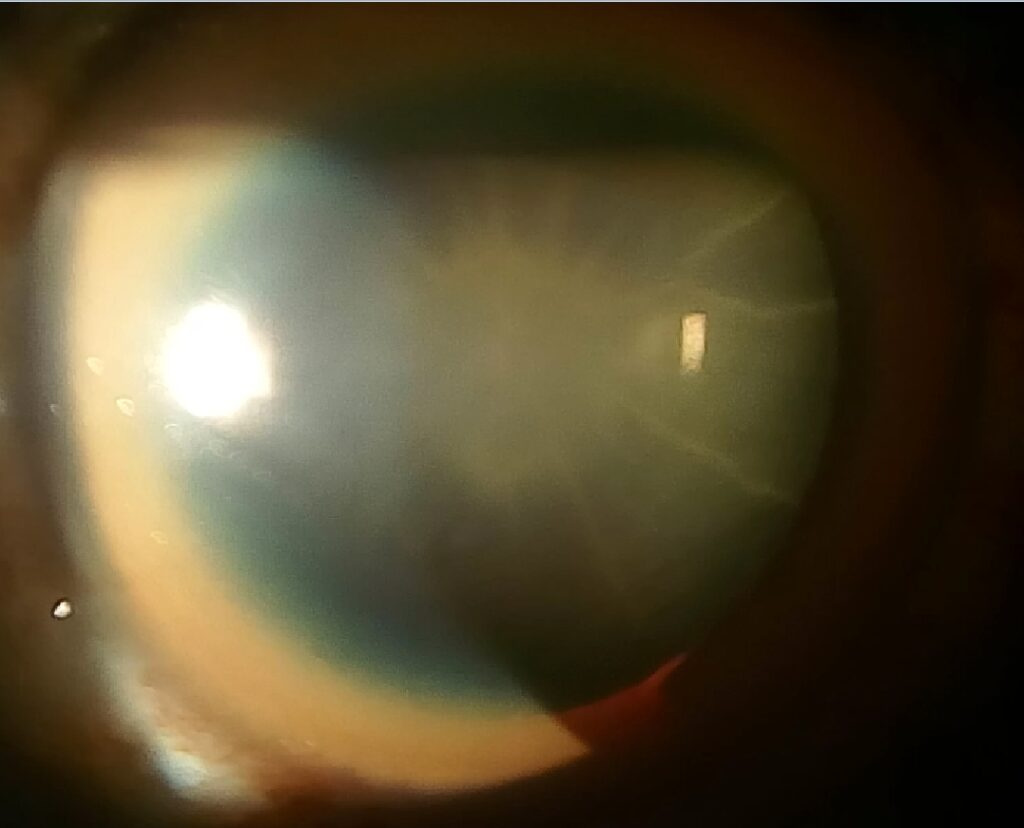 Cataracts