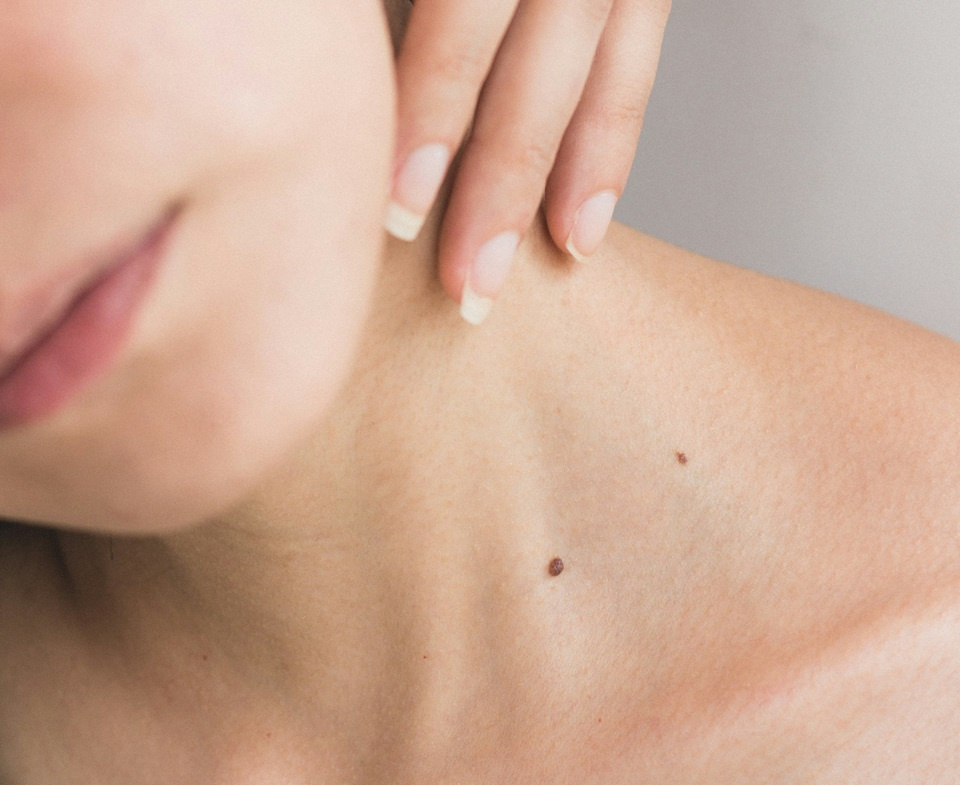 Symptoms of Skin Cancer