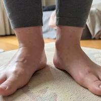 Ultimate Guide to Managing Swollen Ankles and Feet: Causes, Treatments, and Prevention