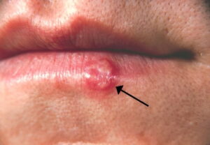 Cold Sores Explained: Causes, Early Symptoms, Effective Treatments, Possible Complications, and Proven Prevention Strategies