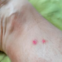 How to Identify and Treat Spider bites - Symptoms and causes