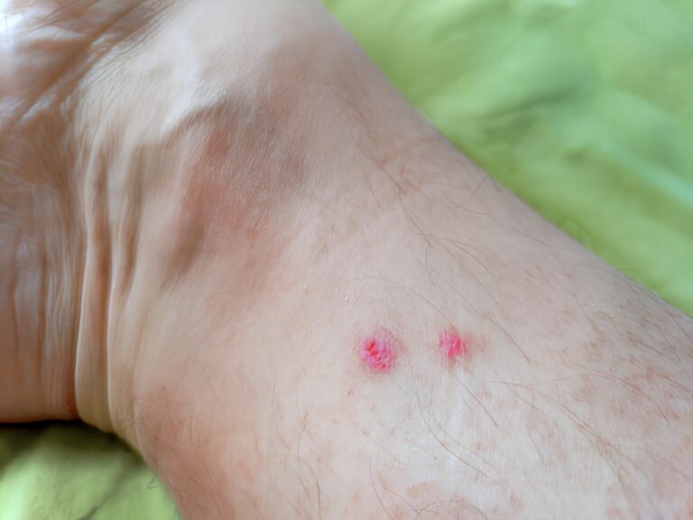 How to Identify and Treat Spider bites – Symptoms and causes