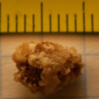 Kidney Stones: Causes, Symptoms, Treatment, and Prevention