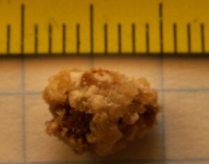 Kidney Stones Symptoms and Causes: Early Warning Signs, Risk Factors, and How They Develop
