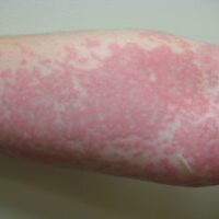 Hives: Causes, Risks, Prevention, and Pictures
