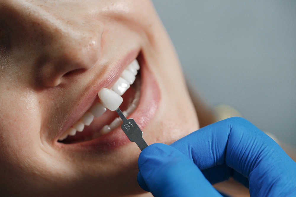 Feature image Dental Veneers