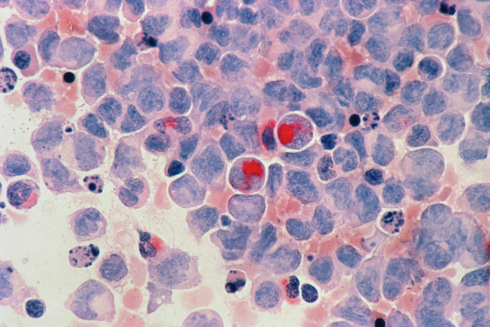 Feature image Leukemia