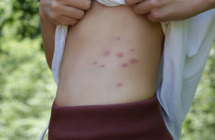 Feature image bed bug bites