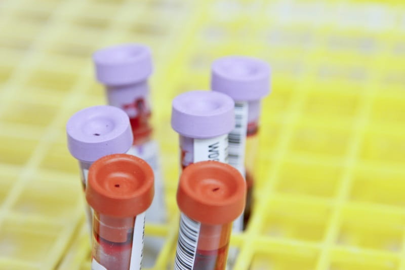 The Essential Guide to Your Blood Urea Nitrogen (BUN) Test: From Purpose to Results