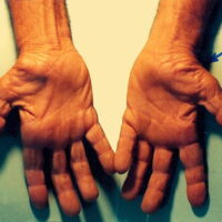 Carpal Tunnel Syndrome: Complete Guide to Symptoms, Causes, Treatment and Prevention