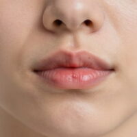 Cold Sores 2026: The Ultimate Guide to Symptoms, Causes, Stages, and Fast Treatment Options