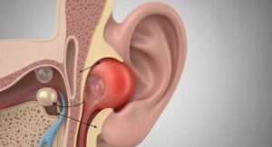 Ear Infection (Middle Ear) - Symptoms & Causes
