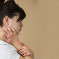 Heat rash - Symptoms & causes