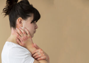 Heat rash – Symptoms & causes