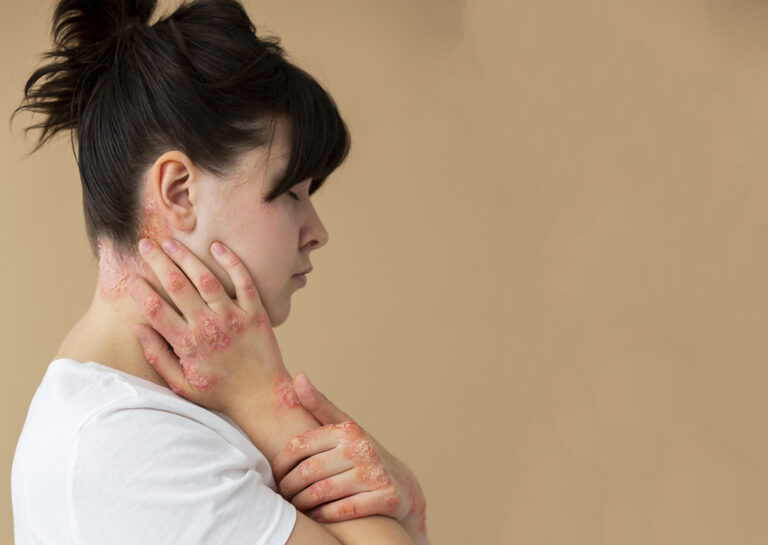 Heat rash – Symptoms & causes