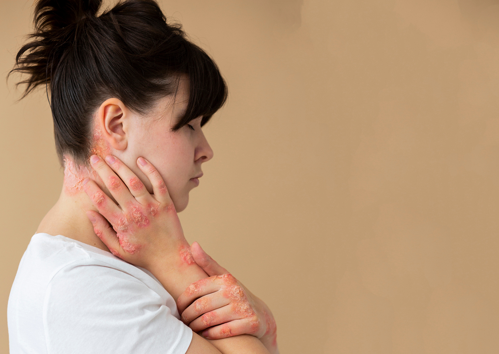 Feature image Heat rash - Symptoms & causes