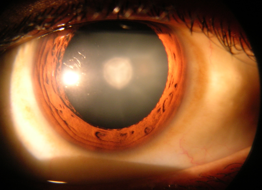 Feature image Cataracts