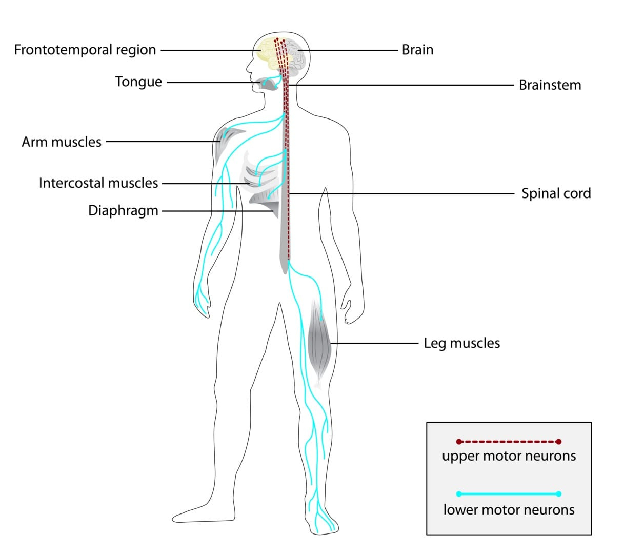Feature image Amyotrophic Lateral Sclerosis (ALS): Symptoms and Causes Explained