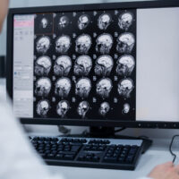 9 Alarming Brain Tumor Symptoms and Causes You Shouldn’t Ignore