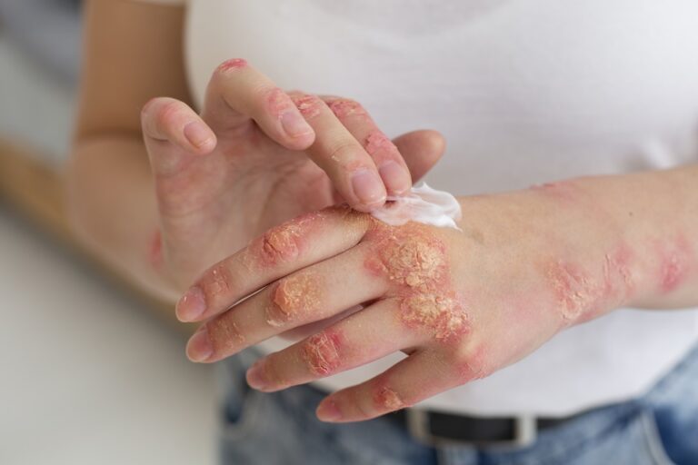 Psoriasis: Symptoms, Causes, Types & Treatment