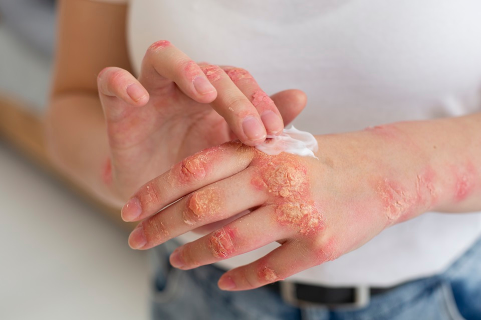 Feature image Psoriasis: Symptoms, Causes, Types & Treatment