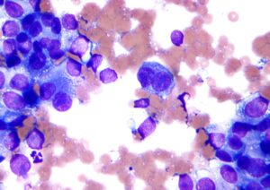 1019px Melanoma cytology field stain