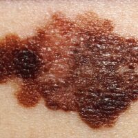 Understanding Skin Cancer: Prevention, Detection, and Treatment