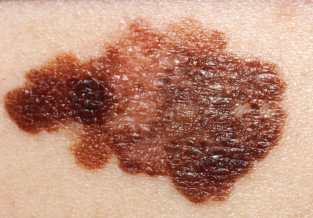 Understanding Skin Cancer: Prevention, Detection, and Treatment, Melanoma