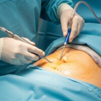 Understanding Liposuction of the Tummy: A Comprehensive Guide