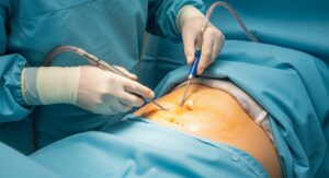 Understanding Liposuction of the Tummy: A Comprehensive Guide
