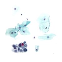 Understanding Pap Smears: Essential Insights for Women’s Health 2 Understanding Pap Smears: Essential Insights for Women’s Health