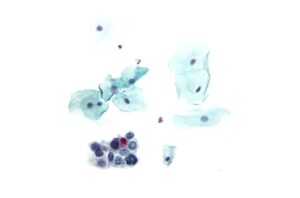 Understanding Pap Smears: Essential Insights for Women’s Health