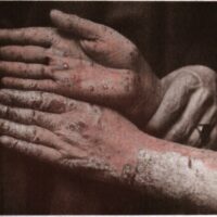 Psoriasis: Understanding Its Symptoms and Causes