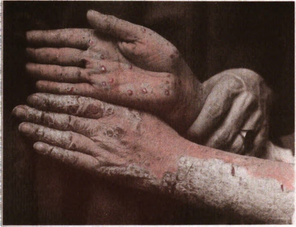 Psoriasis: Understanding Its Symptoms and Causes