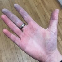 Understanding Raynaud's Disease: Symptoms, Causes, and Effective Management Strategies