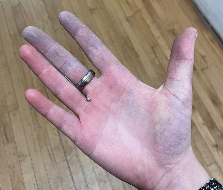 Raynaud’s Disease: Symptoms, Causes and Effective Management Strategies